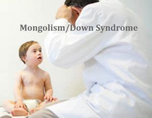 mongolism|mongoloid vs down syndrome.